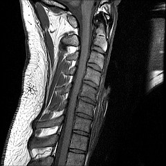 Vitamin D Deficiency and Neurologic Problems